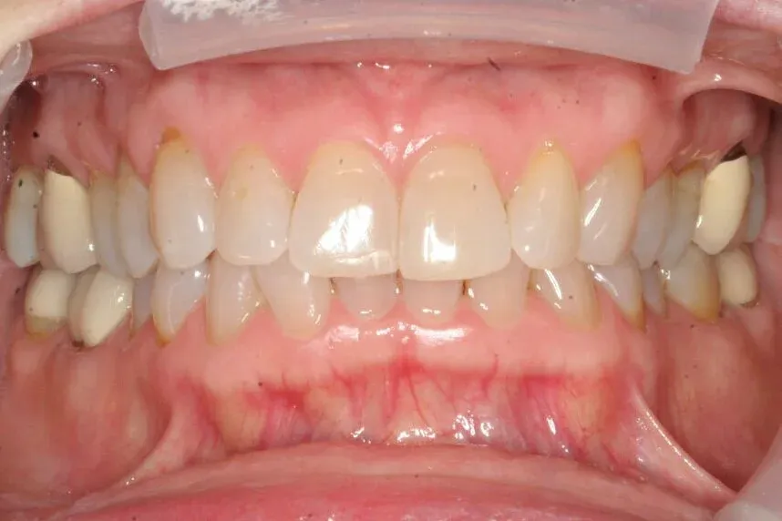 Lurlene Smile Before